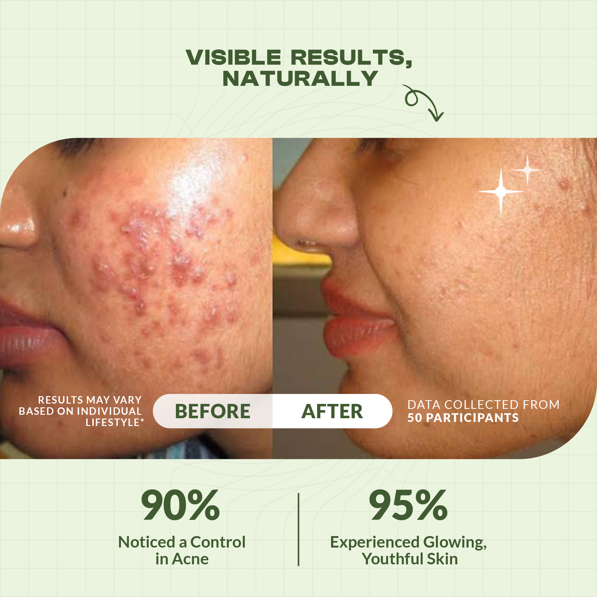 Acne Defense Face Gel With Salicylic Acid, Mandelic Acid & Cinnamon Bark Ext.